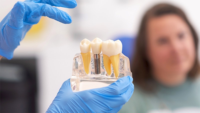 Dental Implants Vancouver, BC Implant Dentistry Norris Dental