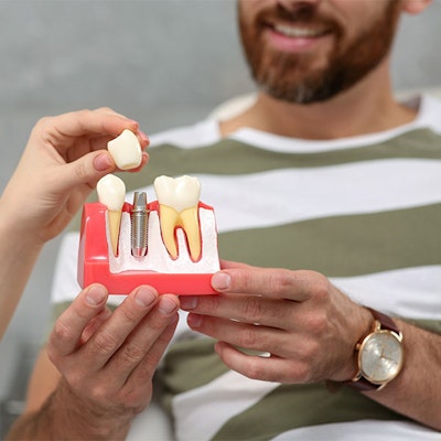 Dental implant model