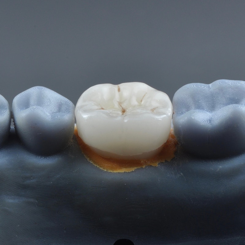 dental crowns on a teeth mold