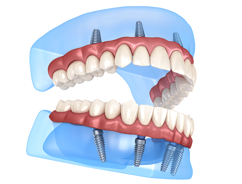 an All-on-4 implant denture illustration