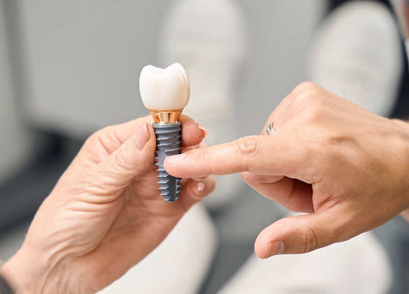 Model of implant crown