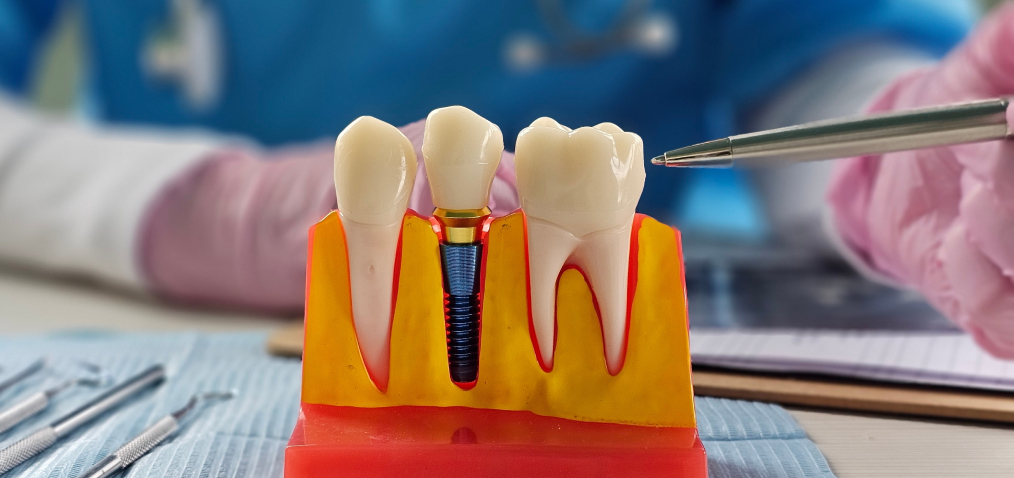 dental implant in model of dental arch
