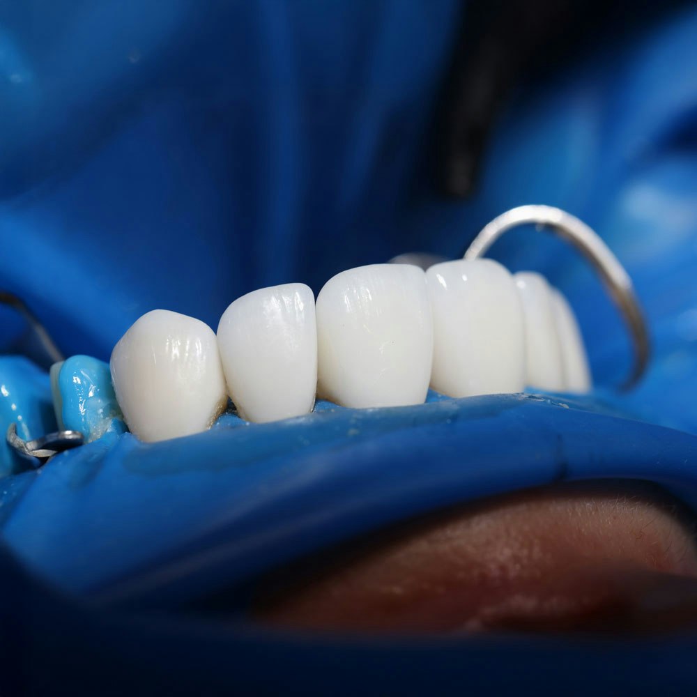 crowns sitting on a model dental arch