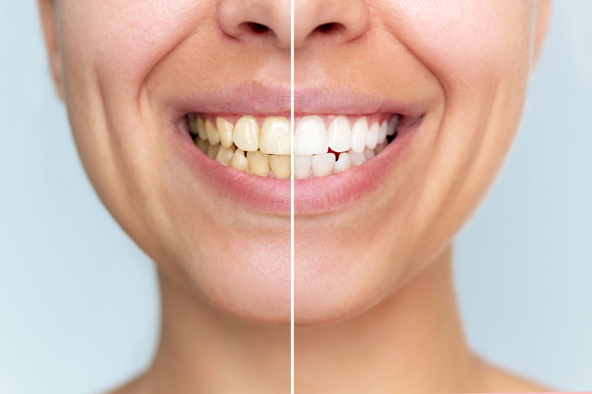 before and after whitening