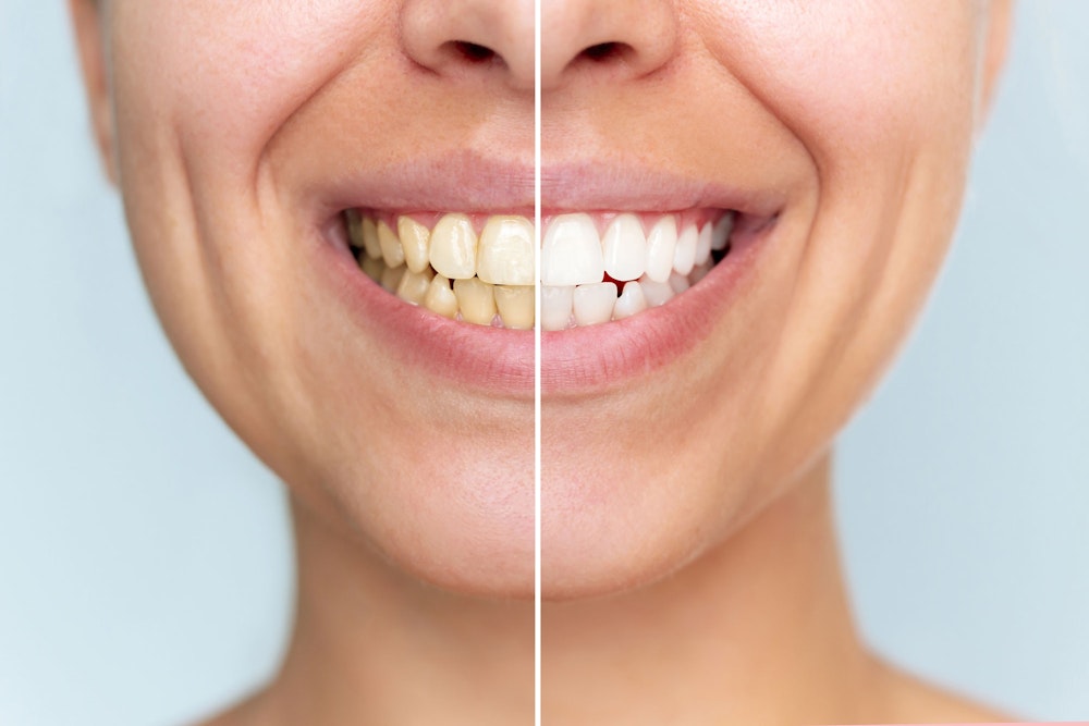 smile before and after whitening