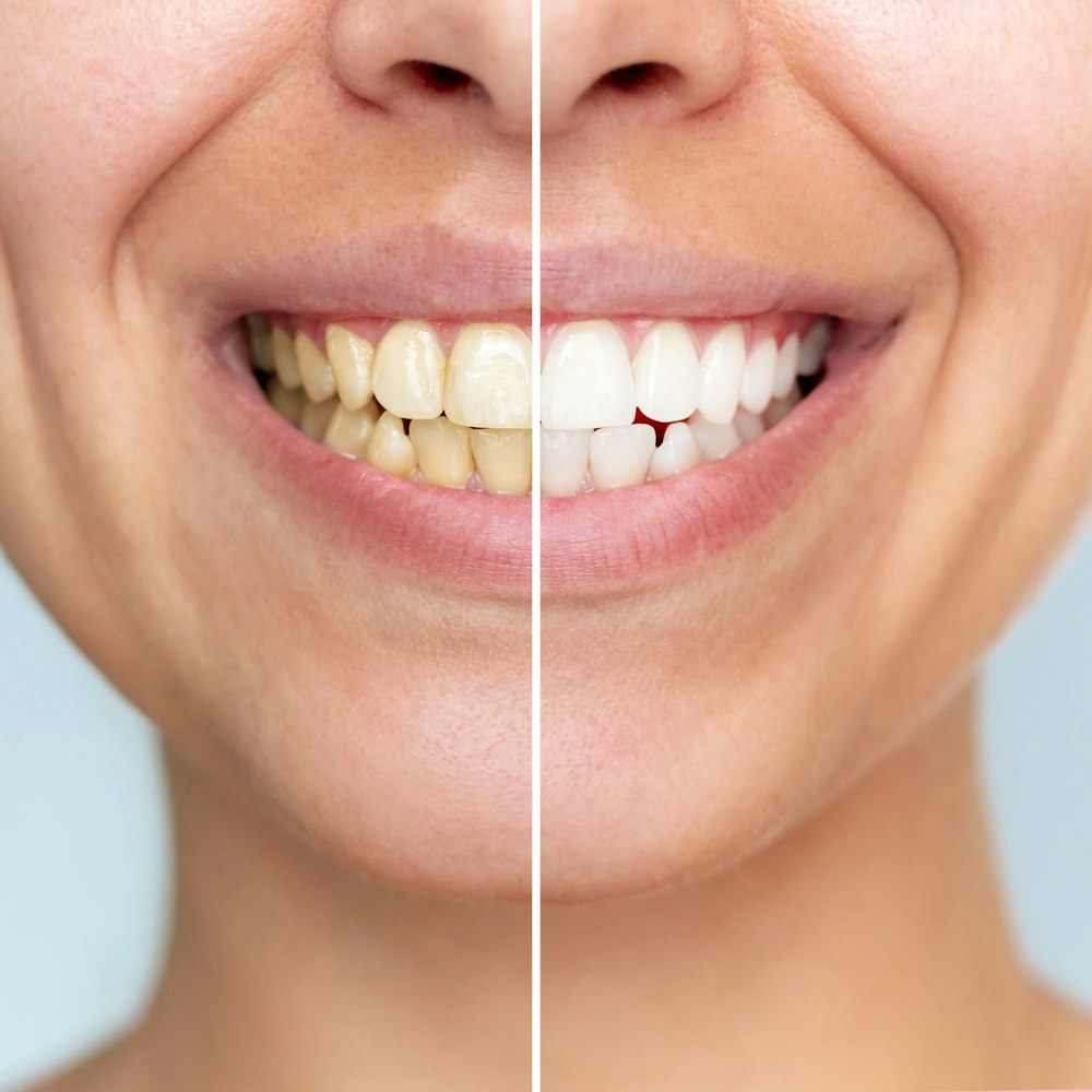 smile before and after whitening