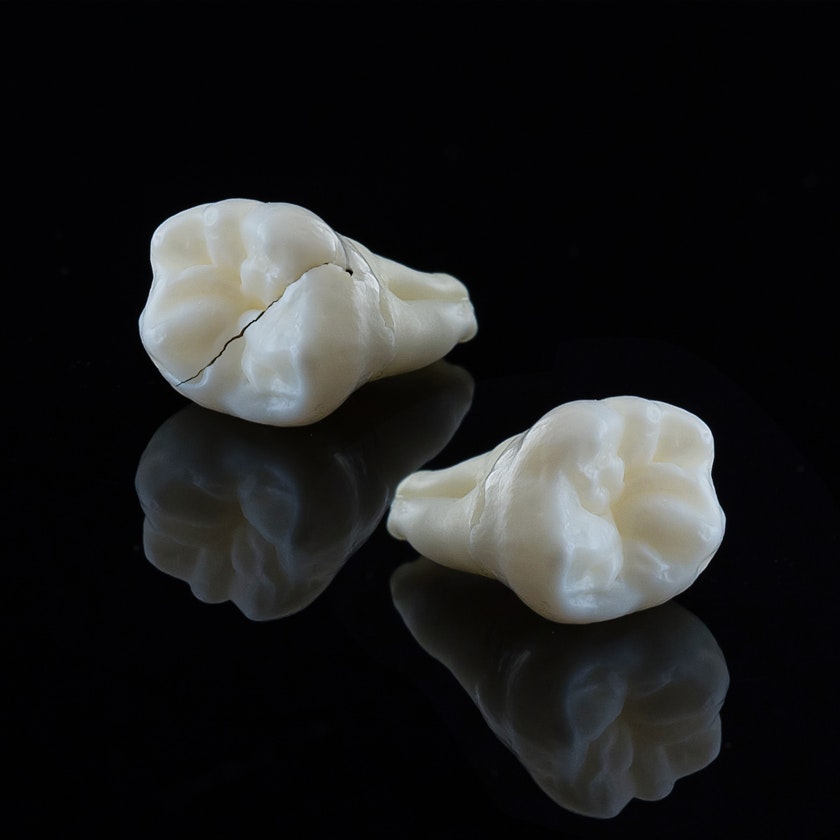 cracked tooth and repaired tooth with bonding