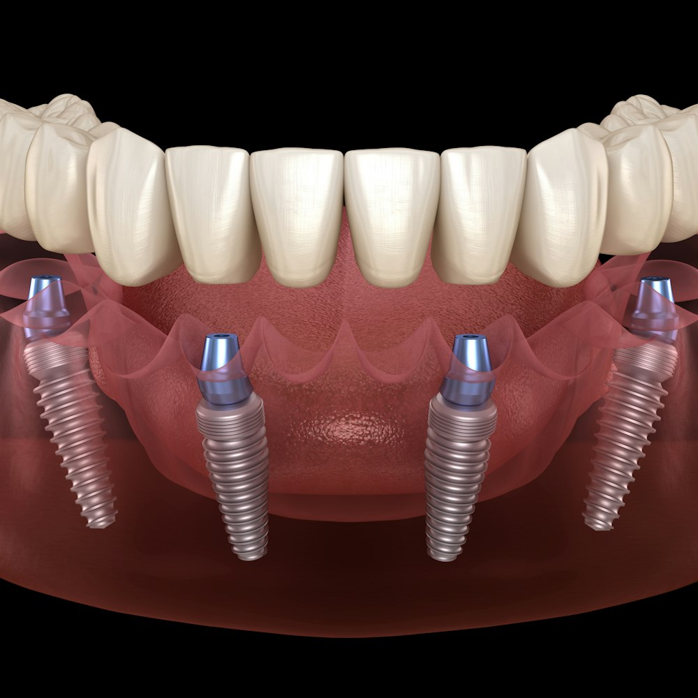 dental implants
