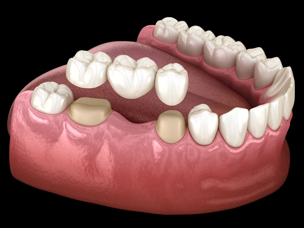 dental bridge