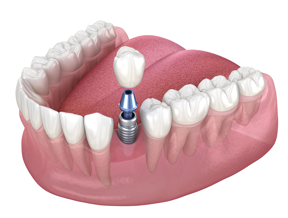 Dental Implants Cost Henderson, NV - Carepoint Dental