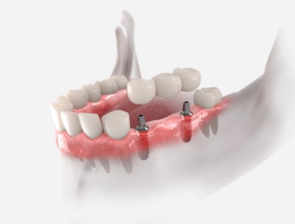 dental bridge
