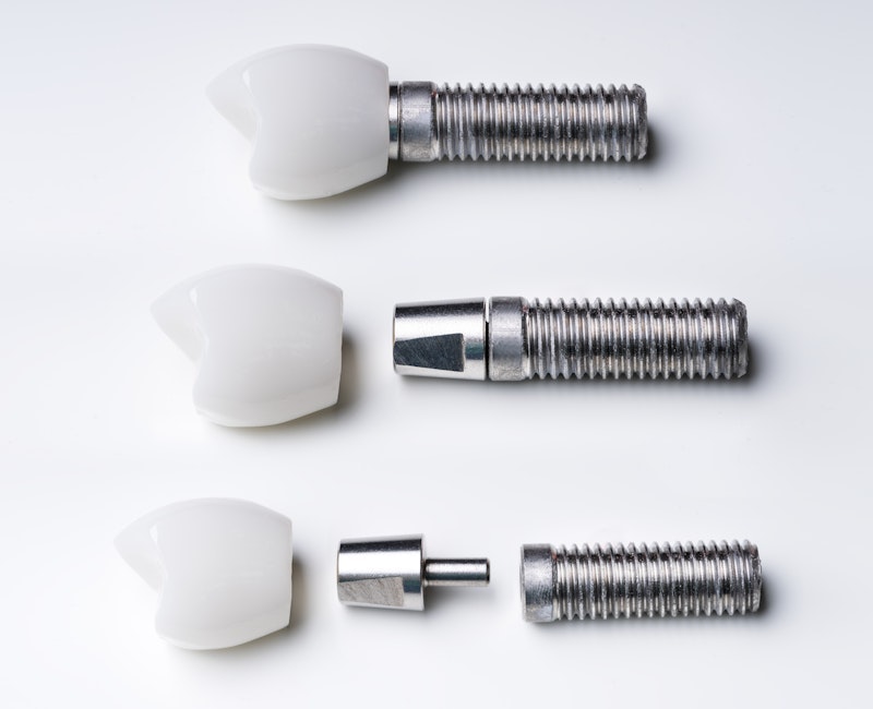 parts of a dental implant
