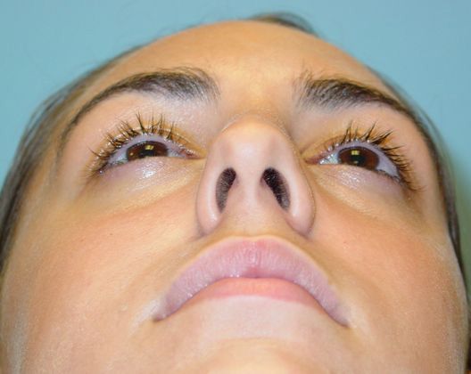 before rhinoplasty