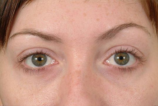 A blepharoplasty (eyelid surgery) patient after lower eye lift
