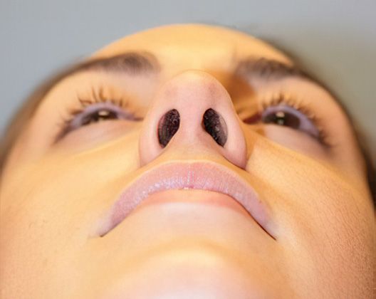after rhinoplasty