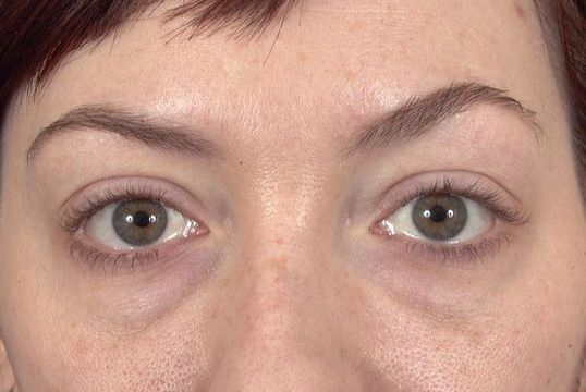 A blepharoplasty (eyelid surgery) patient before lower eye lift