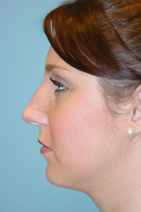 Before Rhinoplasty
