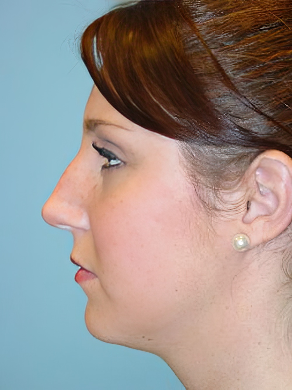 Before Rhinoplasty with Arnold S. Lee, MD