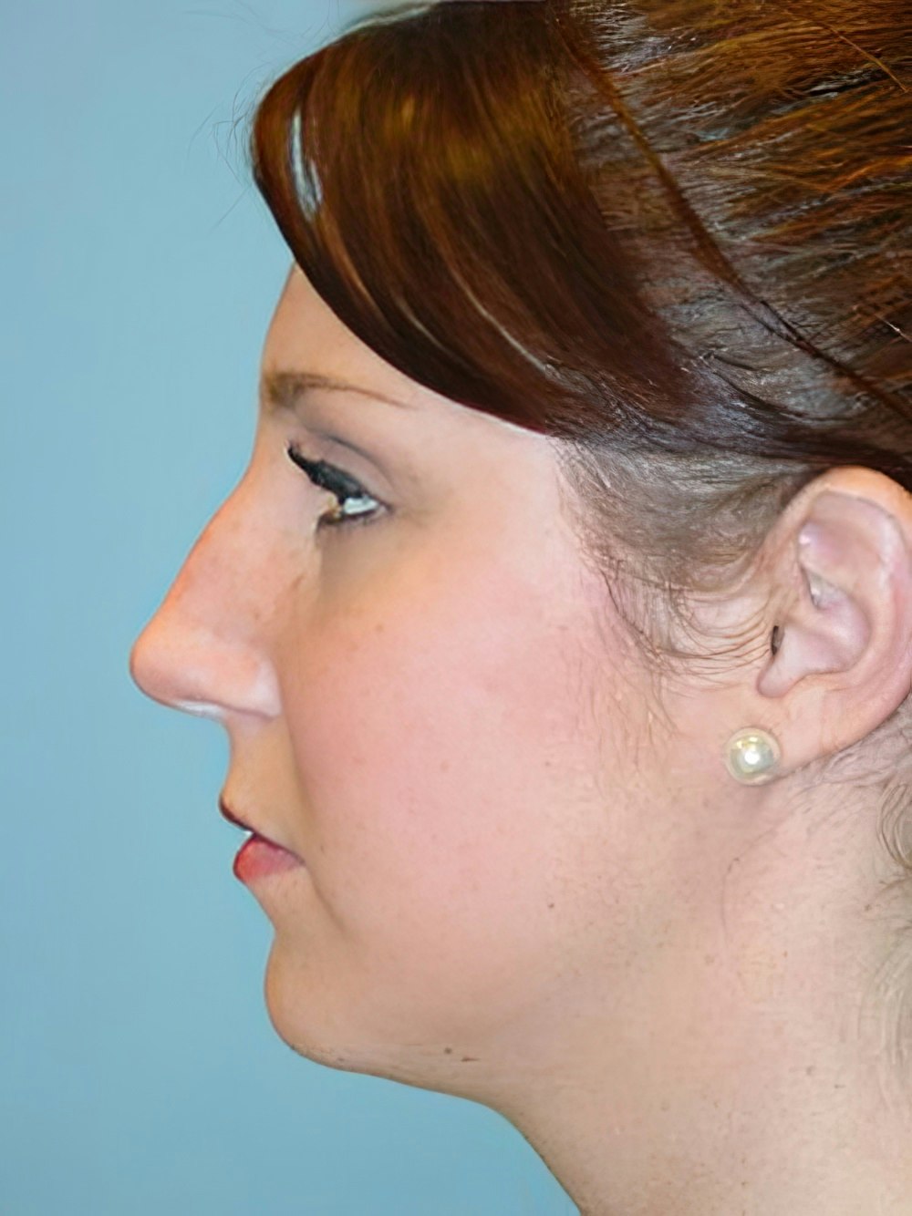 Before Rhinoplasty with Arnold S. Lee, MD