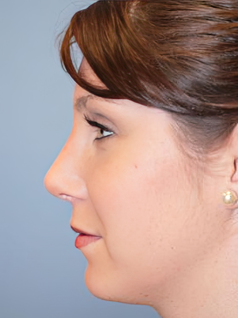 After Rhinoplasty with Arnold S. Lee, MD