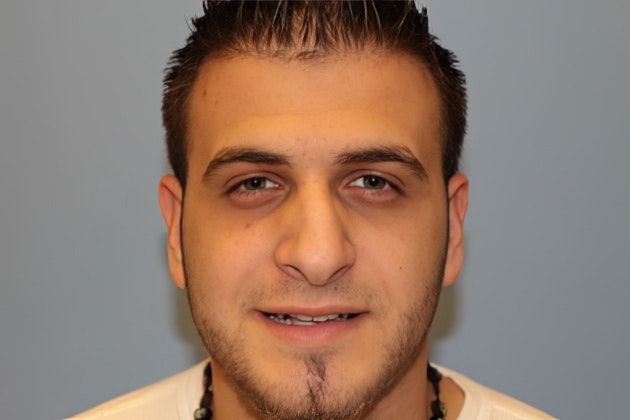 Case 5 before rhinoplasty in Boston, MA, with Lee Facial Plastic Surgery