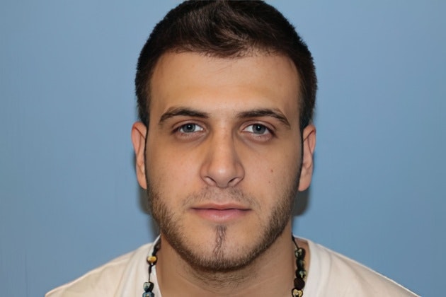 Case 5 after rhinoplasty in Boston, MA, with Lee Facial Plastic Surgery