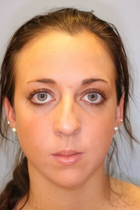 Before rhinoplasty and chin augmentation with our Boston plastic surgery office