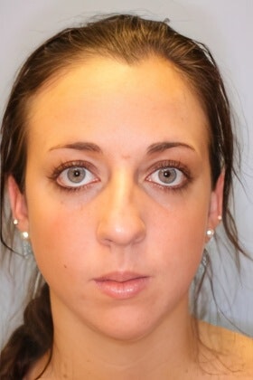 Before rhinoplasty and chin augmentation with our Boston plastic surgery office