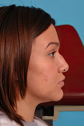 Before rhinoplasty in Boston