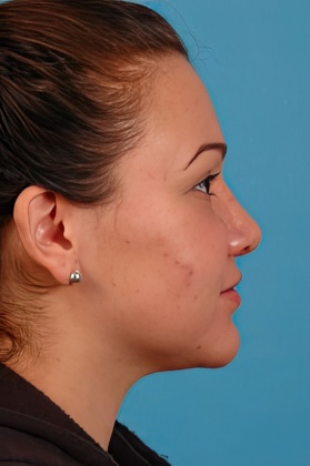 After rhinoplasty