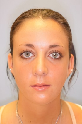 After rhinoplasty and chin augmentation