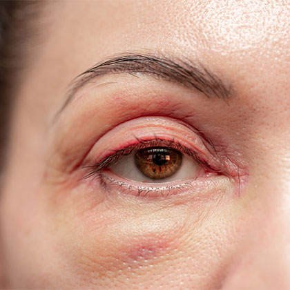 Close up of mature woman's eyelids before blepharoplasty