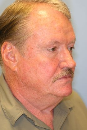 Man before facelift