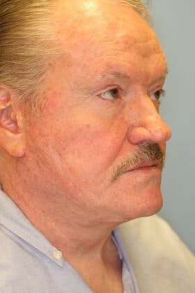 Man after facelift
