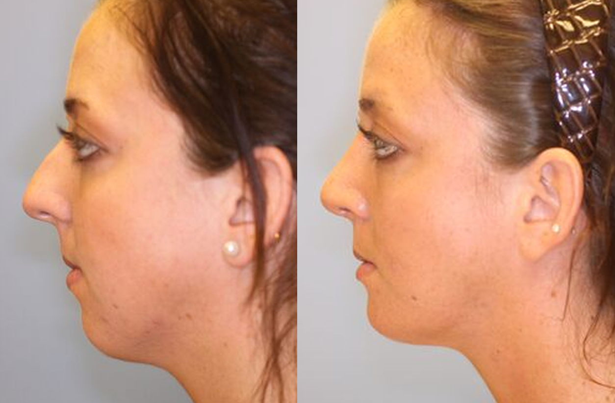 before and after rhinoplasty