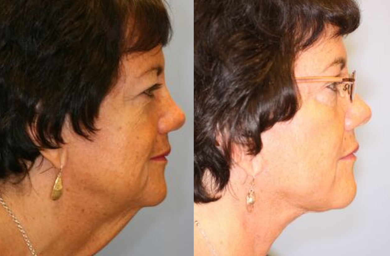 before and after neck lift