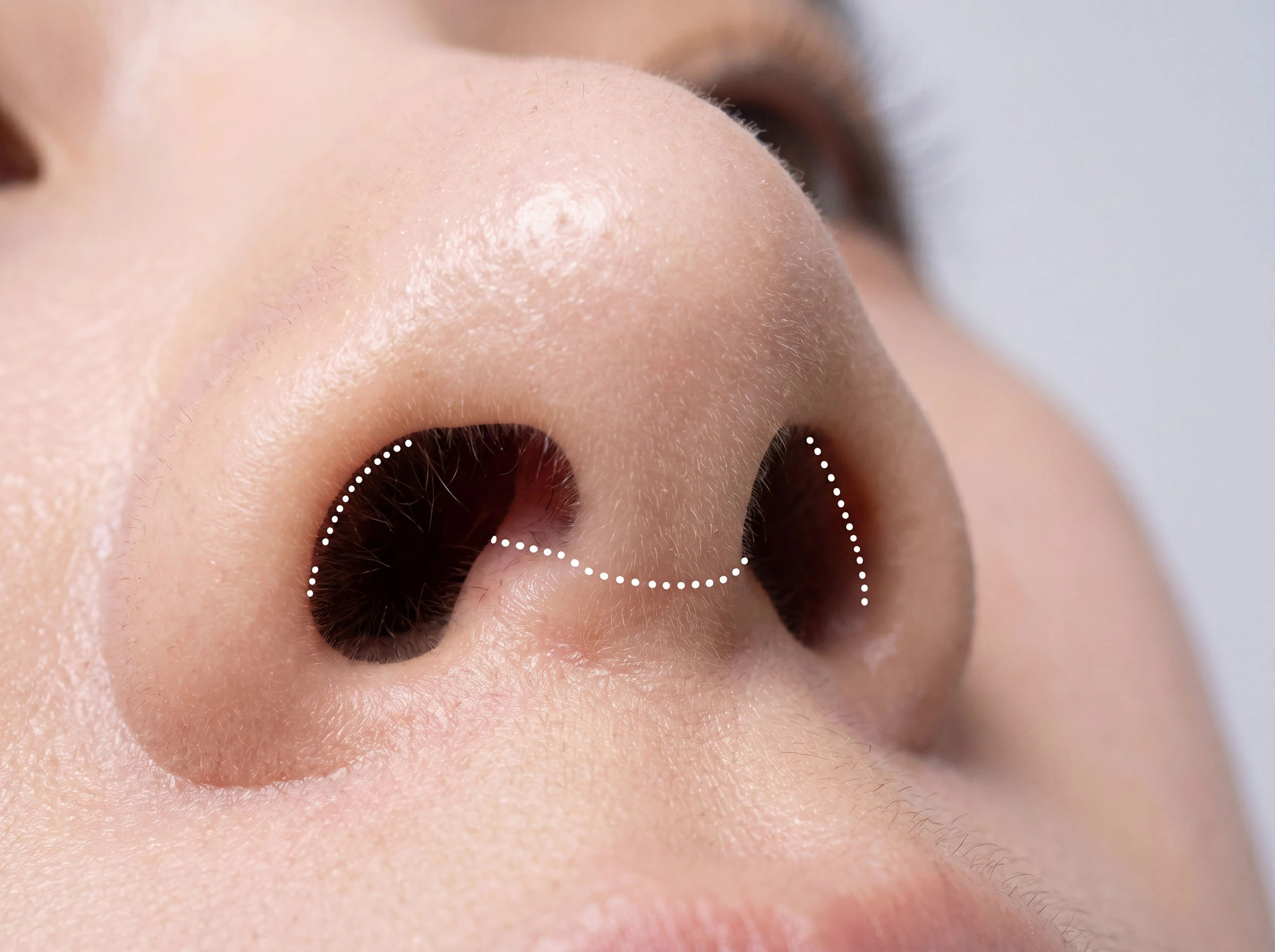 open rhinoplasty incisions