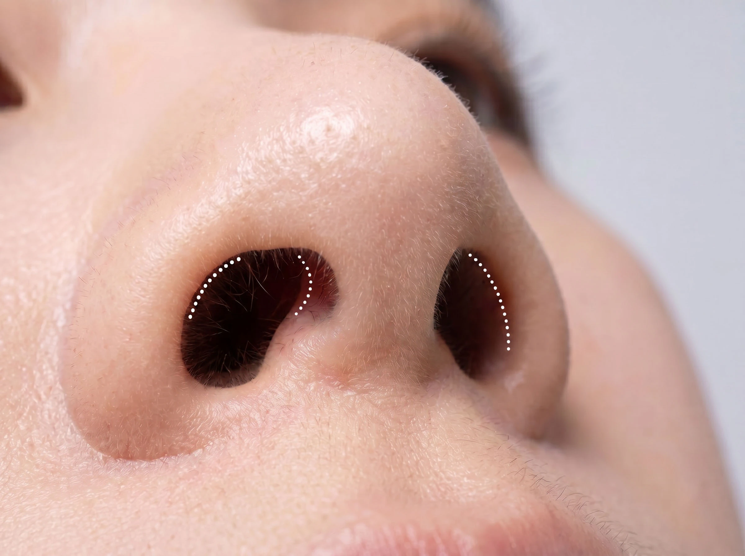 closed rhinoplasty incisions