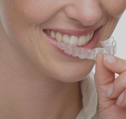 patient placing clear aligner in mouth