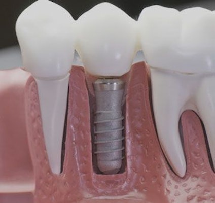 cut out view of dental implant and restoration