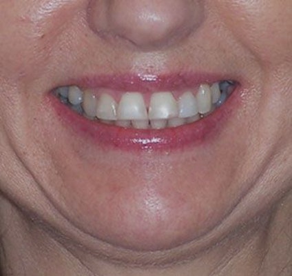 Aging, Worn, Tired Teeth