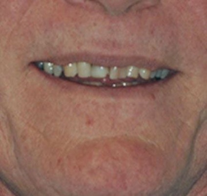 Cracked, Chipped Teeth