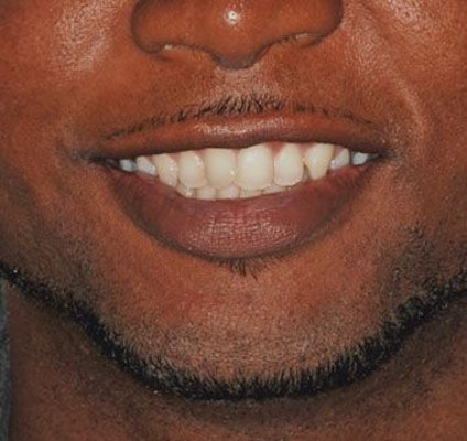 Crooked, Crowded Teeth