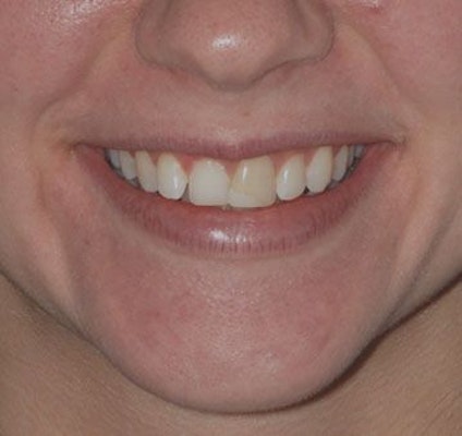 discolored tooth