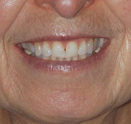 Enamel Erosion