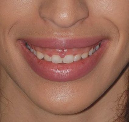 gummy smile