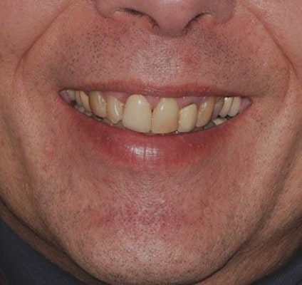 mismatched teeth and crowns