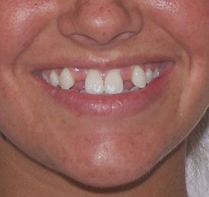 missing teeth