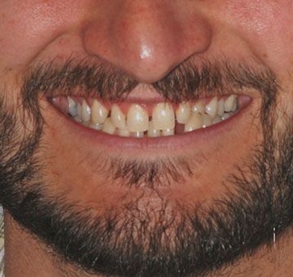 gapped teeth