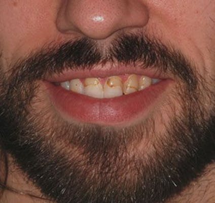 stained teeth